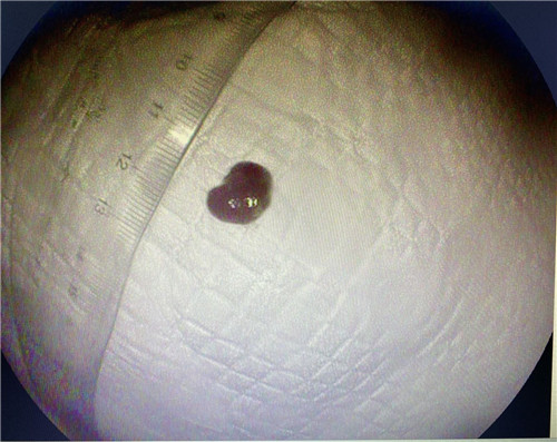 2.息肉.jpg